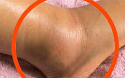 If you notice your legs are swollen, that’s a sign of ca…