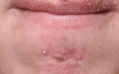 Been dating this woman I met at Walmart and after finally getting some I woke up with these on my face what is this?