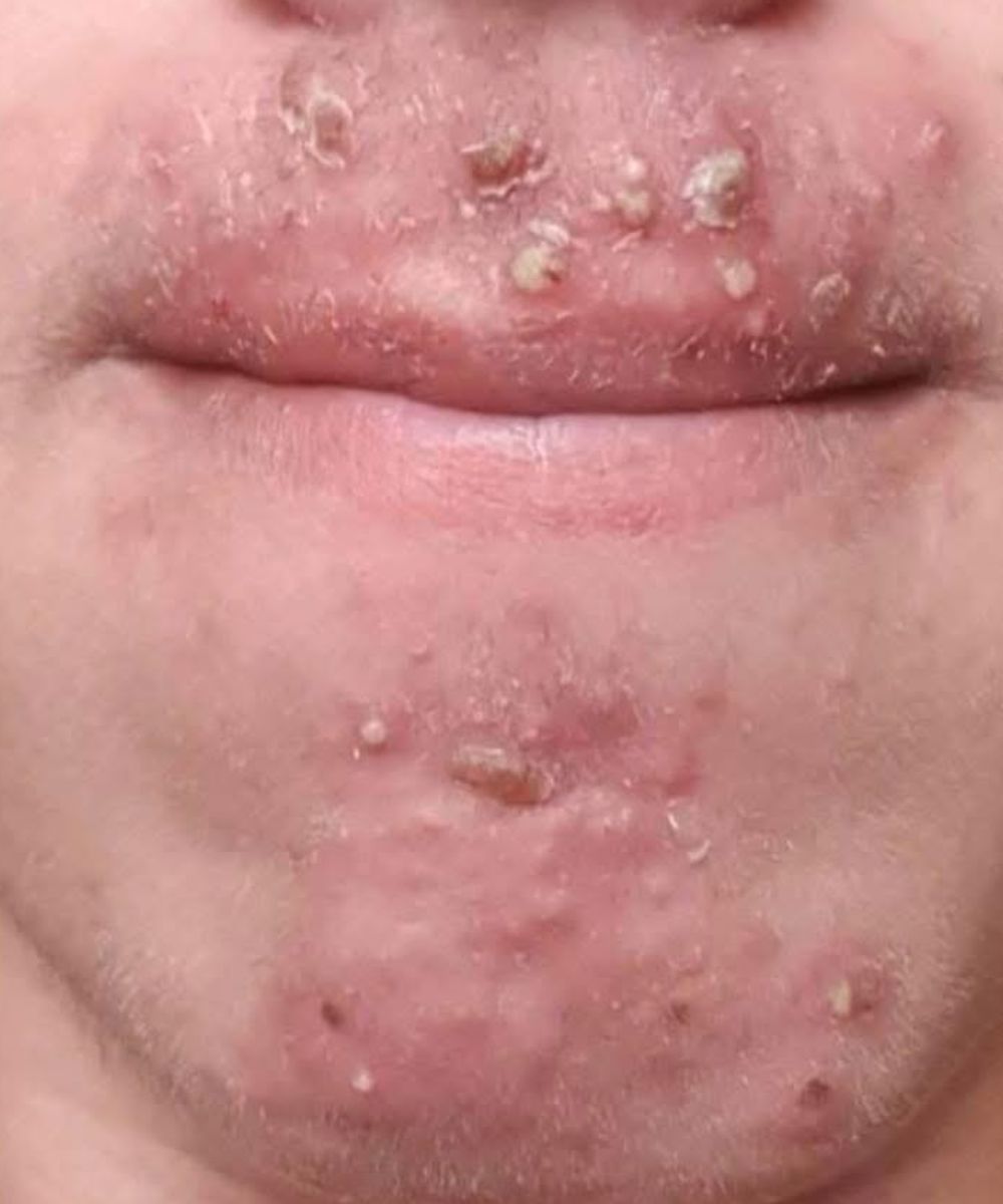 Been dating this woman I met at Walmart and after finally getting some I woke up with these on my face what is this?