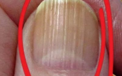 What Vertical Lines on Your Nails Can Reveal About Aging