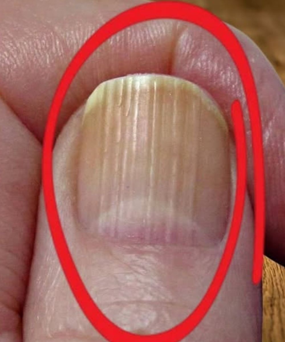 What Vertical Lines on Your Nails Can Reveal About Aging