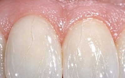I noticed fine cracks forming on my teeth even though I haven’t injured them. What’s causing this?