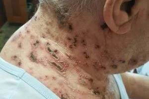 This is the silent disease that is triggered when you come into contact with … See more