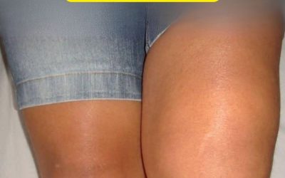 Why Is Only One Knee Swollen?