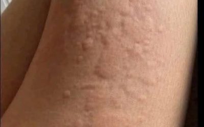 He Thought It Was Just an Allergy – The Diagnosis Surprised Him