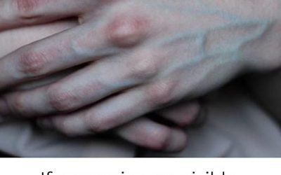 What the Veins on Your Hands Might Reveal About Your Liver Health