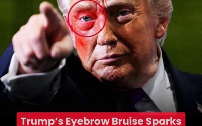Trump’s Eyebrow Bruise Sparks Speculation—Social Media Explodes With Theories About a Possible Fall