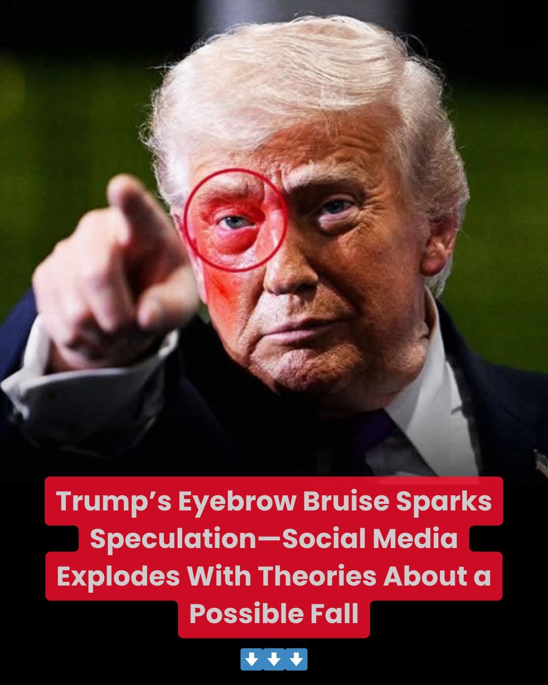 Trump’s Eyebrow Bruise Sparks Speculation—Social Media Explodes With Theories About a Possible Fall