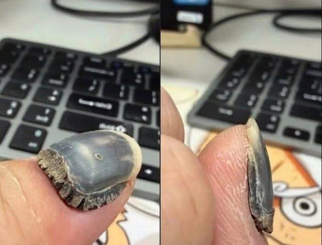 The Hidden Dangers of Neglecting Nail Health