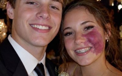 Only One Boy Asked Me to Prom Because No One Else Wanted to Due to the Birthmark on My Face – Everyone Laughed Until an Officer Walked Into the Hall