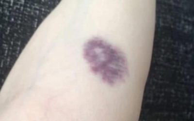 BE CAREFUL, if you get these bruises on your body, it means you have Ca…see more