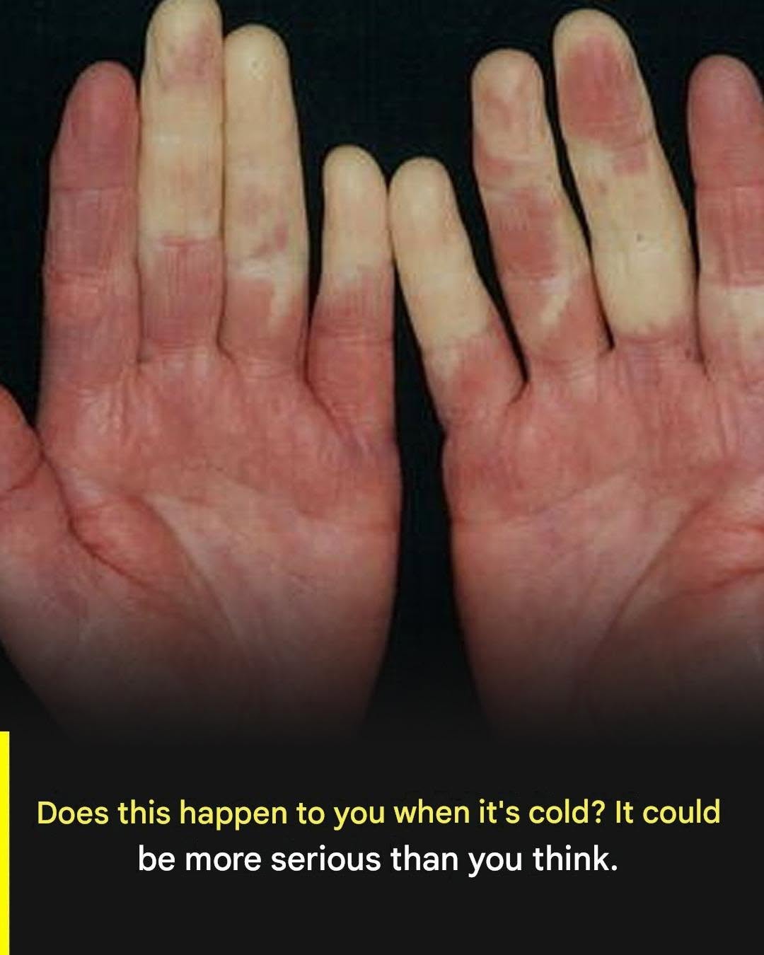 Do your fingers change color in the cold? It could be more serious than you think.