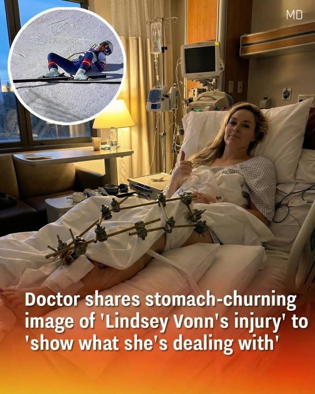 The Olympian’s had three surgeries since the devastating crash.