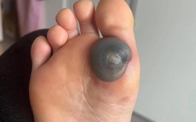 My daughter woke up with this huge spot on her foot I don’t know what it could be. She’s been in pain and can’t move her foot what is this.. Explain this