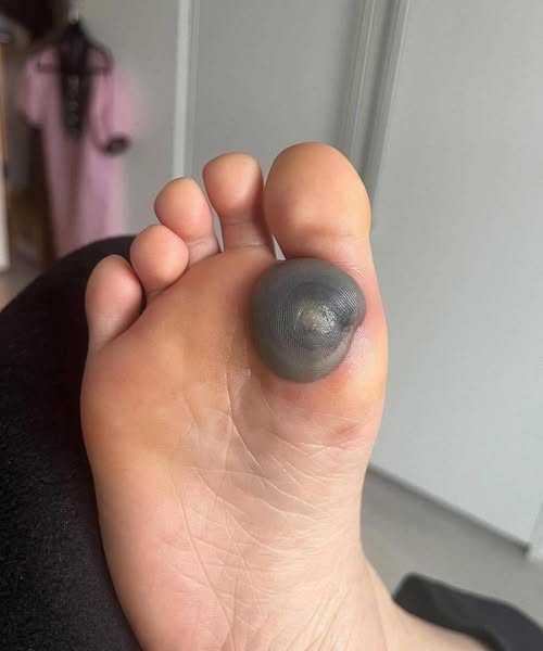 My daughter woke up with this huge spot on her foot I don’t know what it could be. She’s been in pain and can’t move her foot what is this.. Explain this