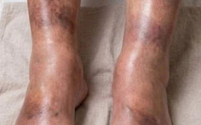 These are consequences of sleeping with…
