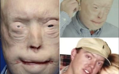 He suffered devastating burns when he tried to rescue a woman trapped in a fire. For years, he was terrified to show his face to the world, and wore caps, sunglasses and prosthetic ears in public. A few years ago, Patrick got the most extensive face transplant ever. I was not ready for how he looks now, and you won’t be either