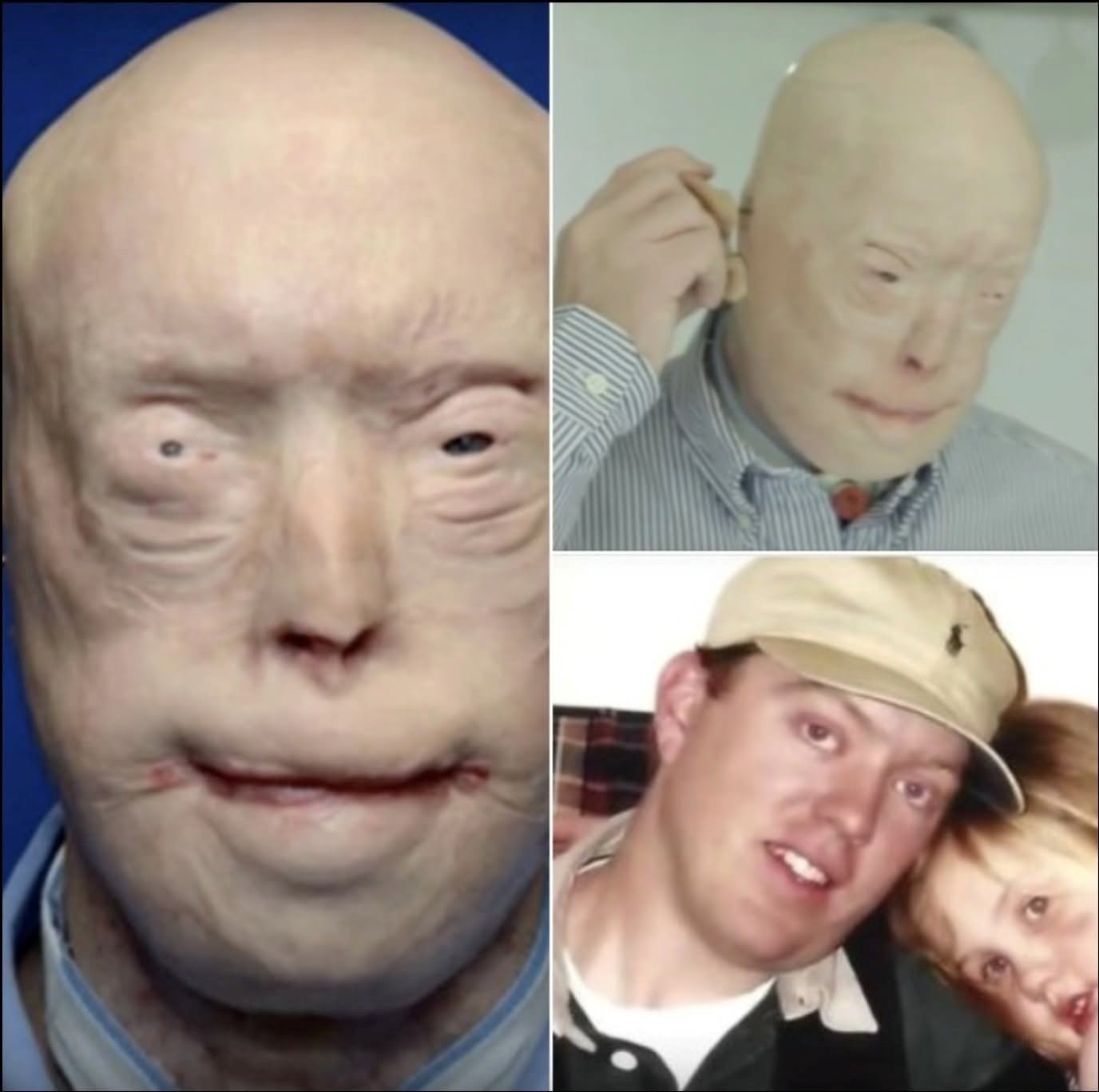 He suffered devastating burns when he tried to rescue a woman trapped in a fire. For years, he was terrified to show his face to the world, and wore caps, sunglasses and prosthetic ears in public. A few years ago, Patrick got the most extensive face transplant ever. I was not ready for how he looks now, and you won’t be either