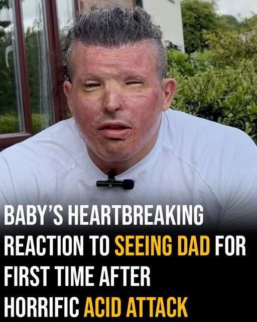 A Father’s Worst Nightmare: After a Horrific Acid Attack Left Him Unrecognizable, Would His Own Toddler Still Love Him?