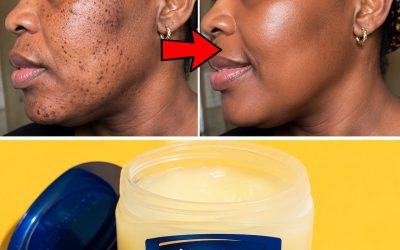 How to remove skin tags naturally at home overnight: the best method with petroleum jelly. » Leave an “OK” to see the recipe in the first comment.