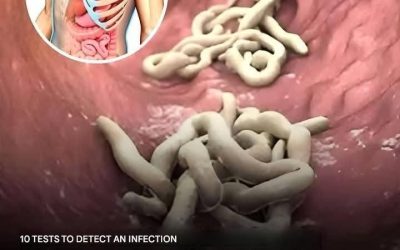 10 Signs That You Have a Parasite Infestation in Your Body?