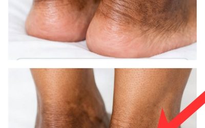 These are the first symptoms of a…