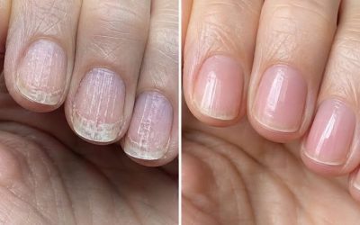 Soak your nails in this 1 mixture and get rid of brittle ridges, vertical lines, and flaky layers