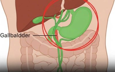 After Gallbladder Removal: 3 Conditions You Could Develop — Why You Should Avoid the Surgery When Possible