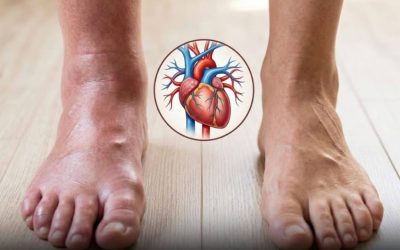 A month before a heart attack, your feet warn you of these six signs.