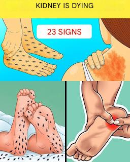 🚨 23 Warning Signs Your Kidneys May Be Asking for Help