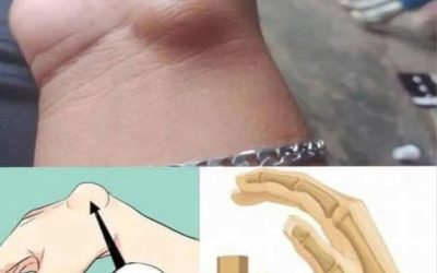 Be Careful: If You Get These Bruises on Your Body, It Might Mean Something Serious