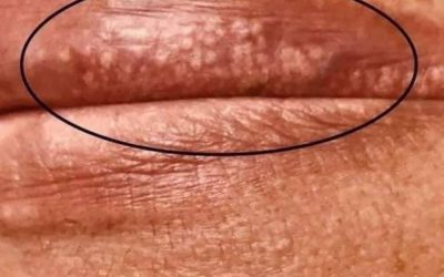 If you are getting these pimples on your lips or int;im:ate area, it is because…