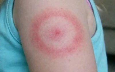 My Daughter Woke Up With a Strange Red Ring on Her Arm: A Parent’s Guide to Ring-Shaped Rashes (And When to Breathe Easy)