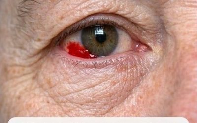 My 64-year-old husband woke up with a red, bleeding spot on his eye. Should we go to the hospital?