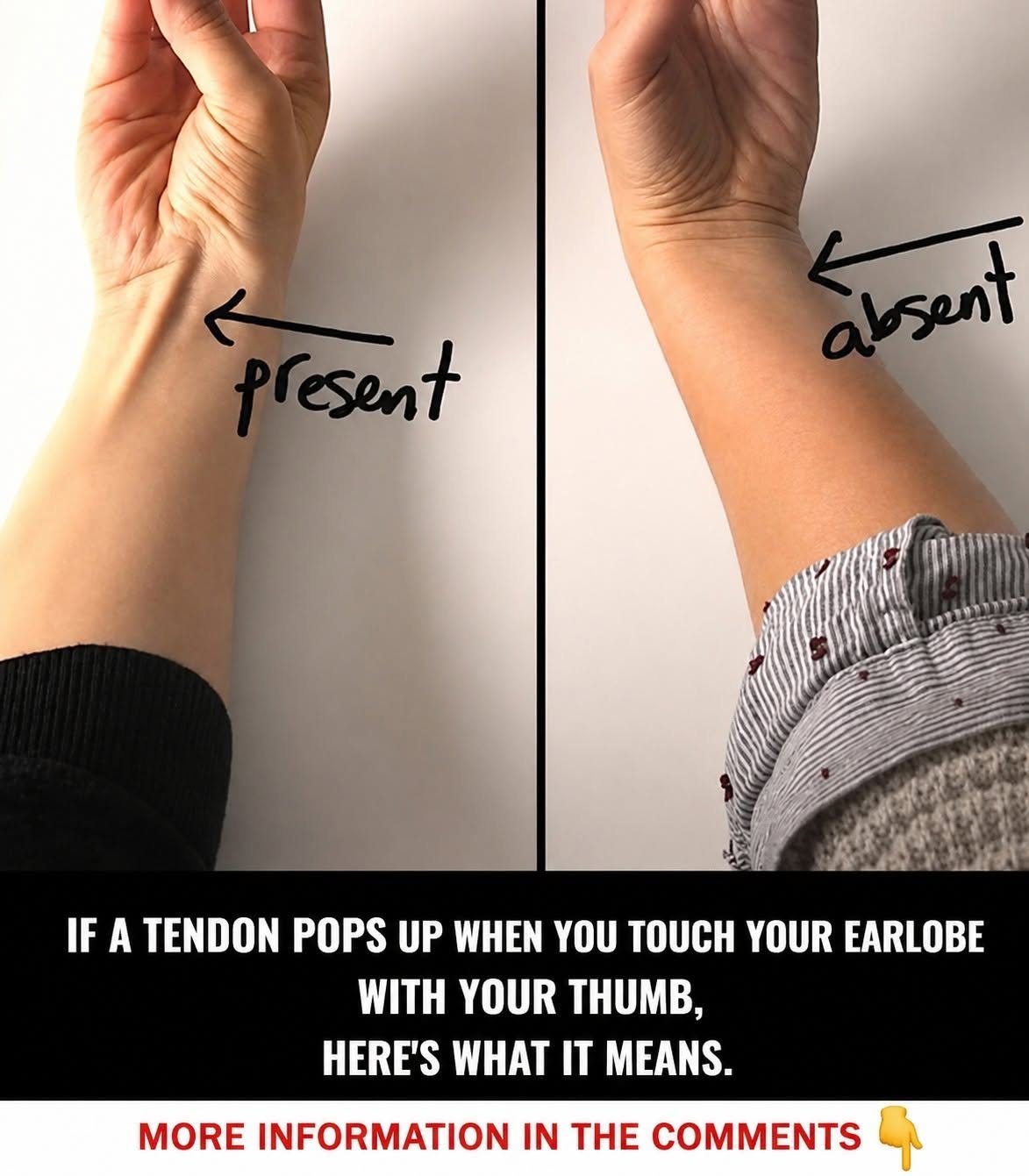 If a tendon lifts when you touch your little finger with your thumb, here’s what it means