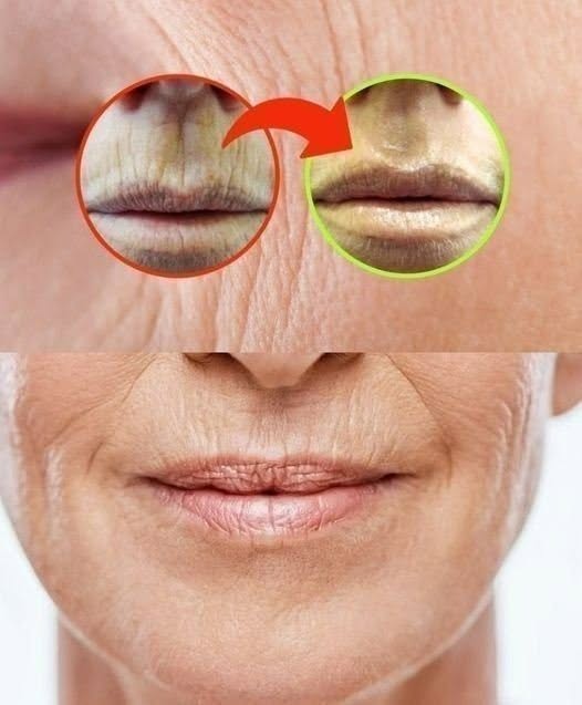 WRINKLES ON THE MOUTH, NO NEED TO WASTE TIME WITH CREAMS: THE REMEDY IS IN THE PANTRY..see more below