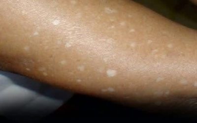 Small White Spots on Arms and Legs You Need To Know