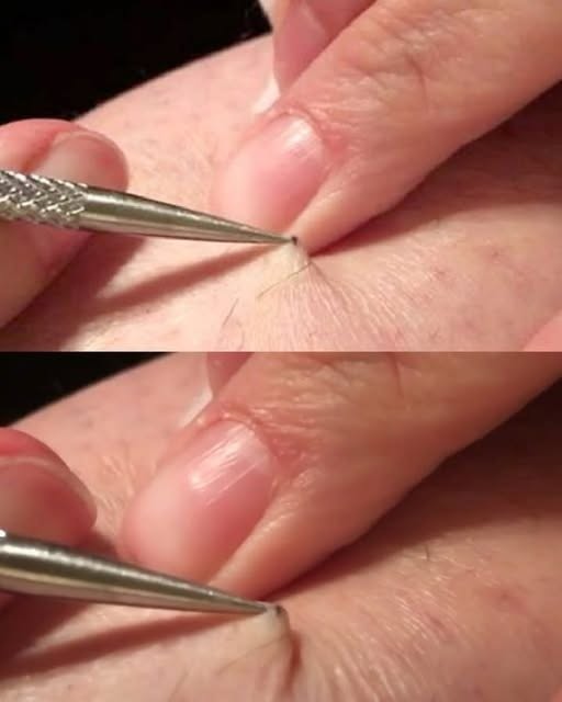 It all started with an itch, and ended in shock! A man found a black spot on his leg and started picking it off… what he removed left millions of people speechless.