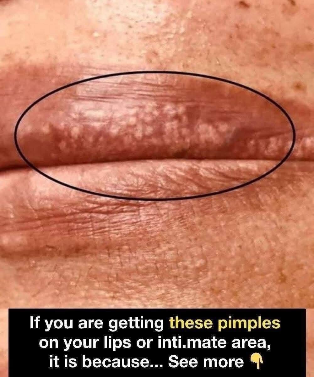 If you are getting these pimples on your lips or int;im:ate area, it is because… See more