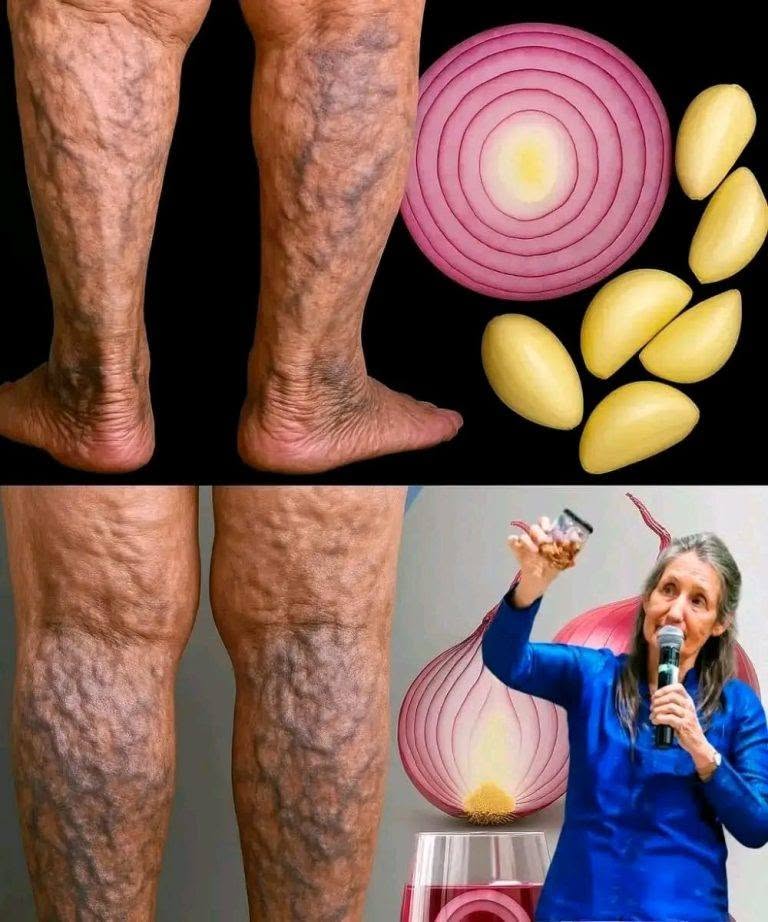 Natural and Effective Way to Say Goodbye to Varicose Veins