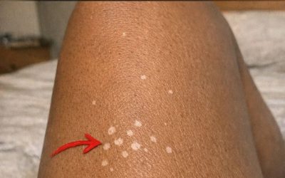 Why do white spots appear on the skin?