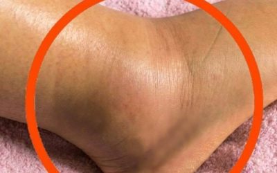 If You Notice Your Legs Are Swollen, Doctors Warn It Could Be a Sign of..see more below