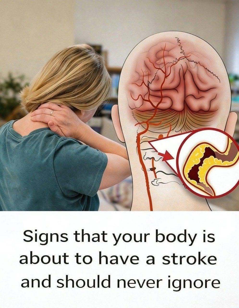 10 Early Warning Signs of a Stroke Everyone Should Know