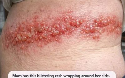 “Mom has this blistering rash wrapping around her side. She says the burning pain is unbearable. ER wait is 8 hours! What can we do?. Full article 👇 💬”