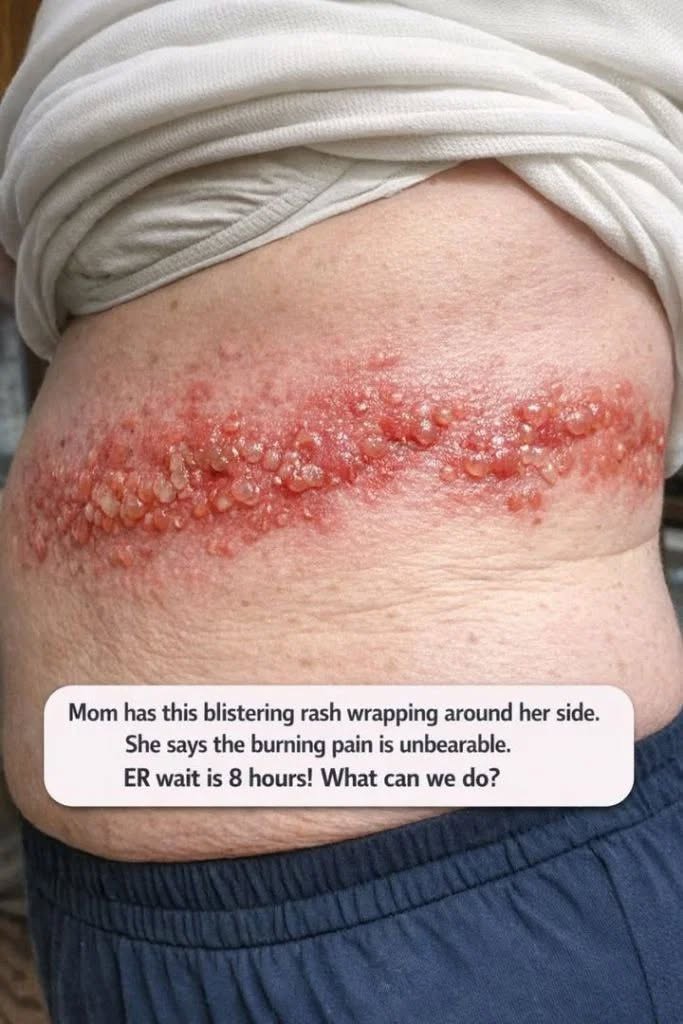 “Mom has this blistering rash wrapping around her side. She says the burning pain is unbearable. ER wait is 8 hours! What can we do?. Full article 👇 💬”