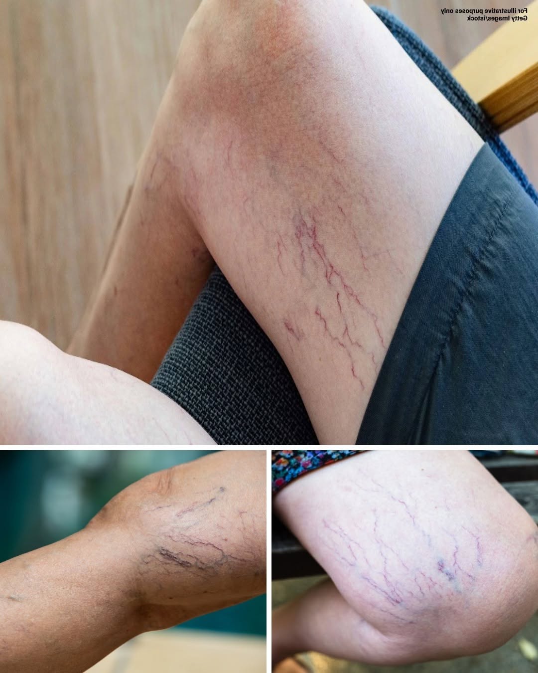 What Do Purple Veins on Your Legs Mean? Understanding the Common Causes What Do Purple Veins on Your Legs Mean? Understanding the Common Causes