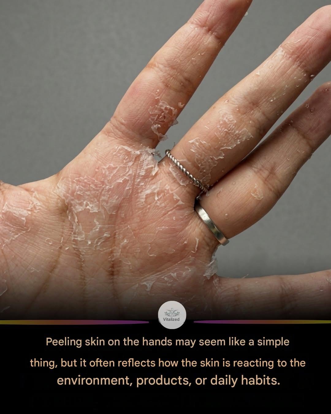 Peeling Skin on Your Hands? What It May Mean and How to Care for Your Skin Barrier