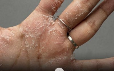 Peeling Skin on Your Hands? What It May Mean and How to Care for Your Skin Barrier