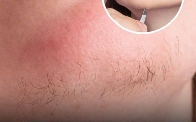 A: woman’s chin hair is a sign of…See more