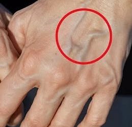 If you have visible veins, it means you are… See more